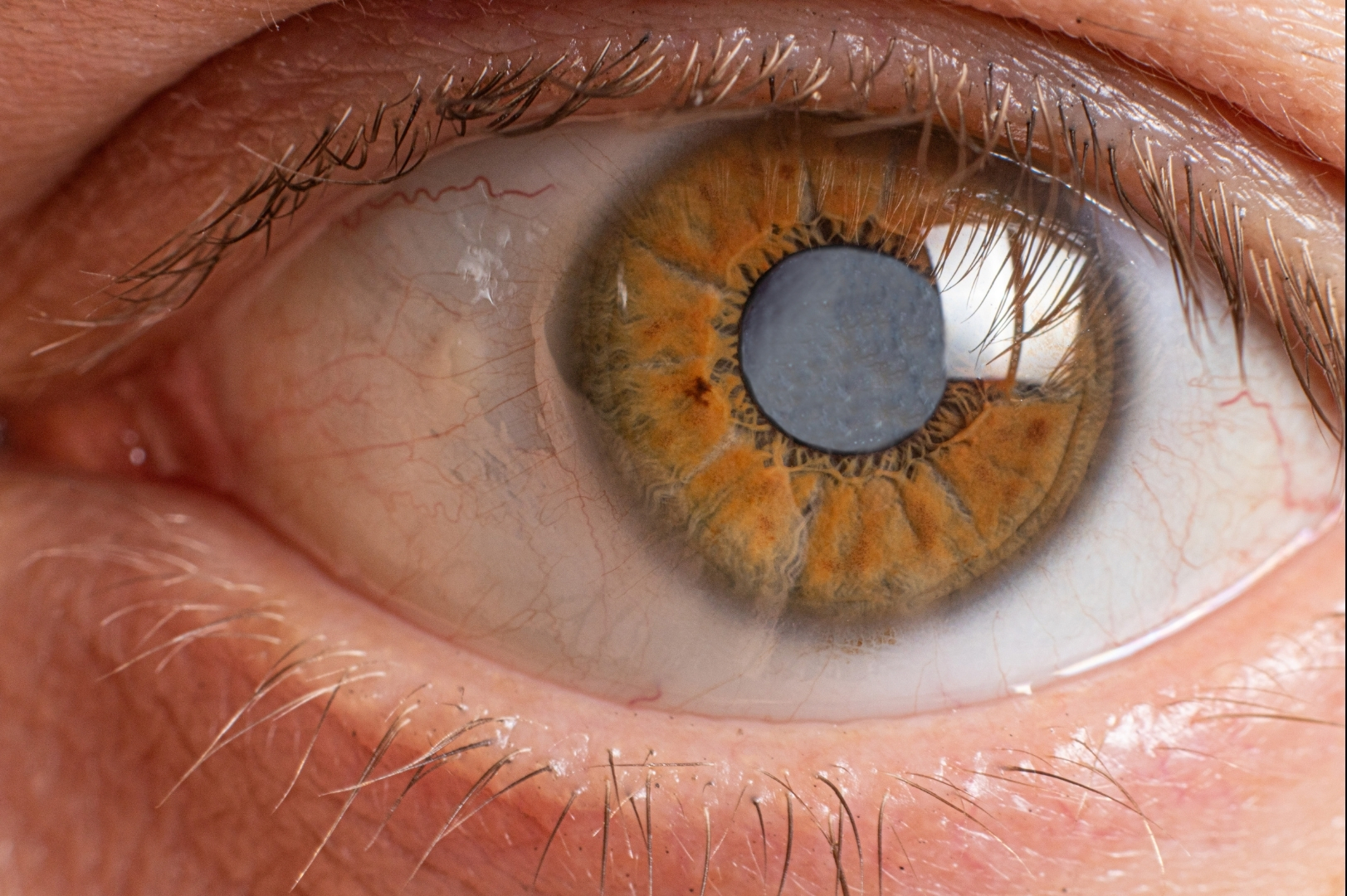 Expert Warns: Delayed Treatment of Childhood Cataracts Can Cause Lasting Vision Loss