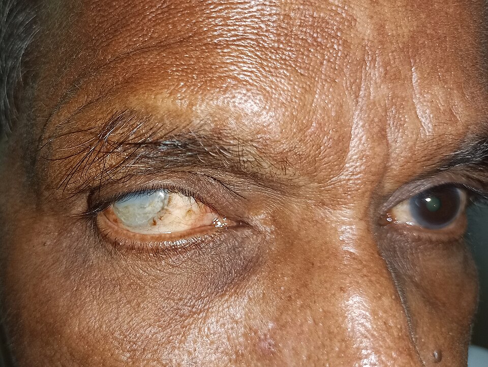 Over Two Million Nigerians Face Blindness from Cataracts