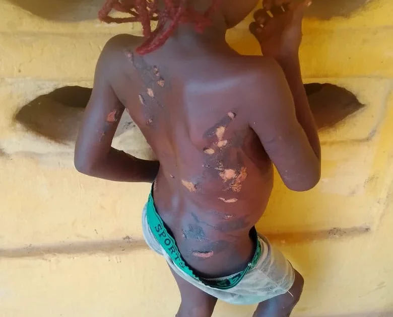Mother Arrested in Anambra for Burning Daughter with Hot Knife