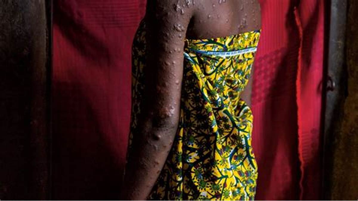 11 African countries report 1,153 mpox cases in six weeks